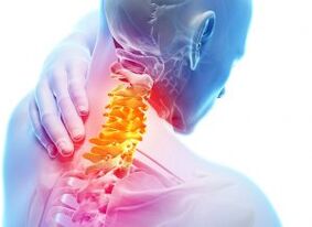 Douleur et abris dans la zone cervicale avec le troisième degré d'ostéochondrose