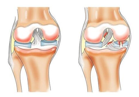 genou sain et arthrose de l'articulation du genou