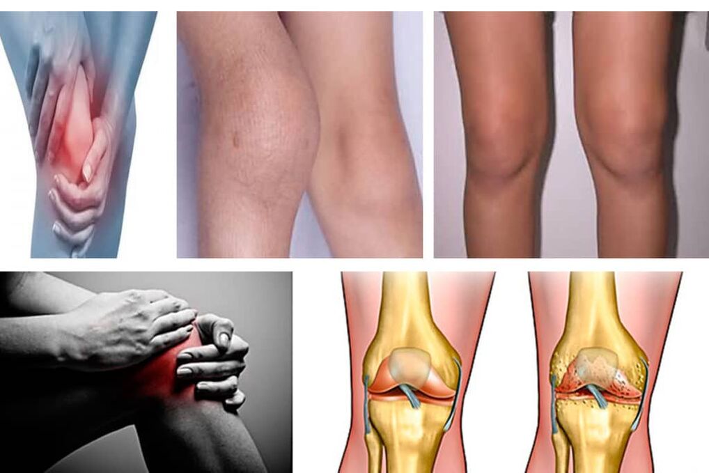 Symptômes d'arthrose du genou